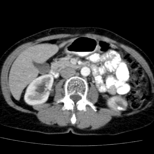 File:Atypical renal cyst (Radiopaedia 17536-17251 renal cortical phase 20).jpg