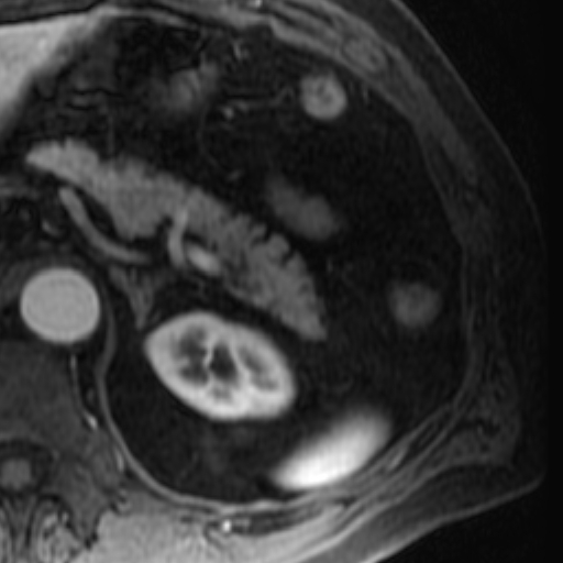 File:Atypical renal cyst on MRI (Radiopaedia 17349-17046 C 6).jpg