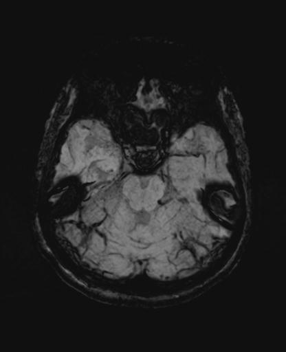 Autoimmune limbic encephalitis (Radiopaedia 30363-31005 SWI - mIP 23).jpg