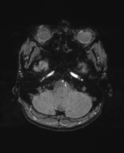 File:Autoimmune limbic encephalitis (Radiopaedia 30363-31005 SWI - magnitude 13).jpg