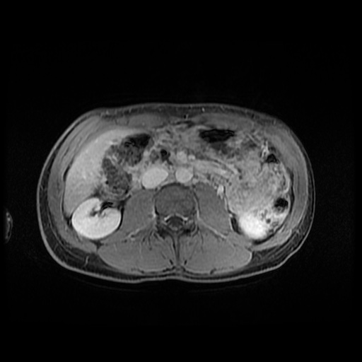 Autoimmune pancreatitis (Radiopaedia 69751-79729 N 88).jpg
