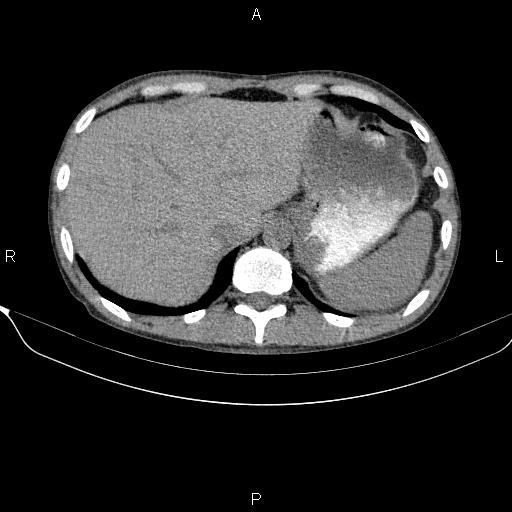 Autoimmune pancreatitis (Radiopaedia 84925-100431 Axial non-contrast 12).jpg