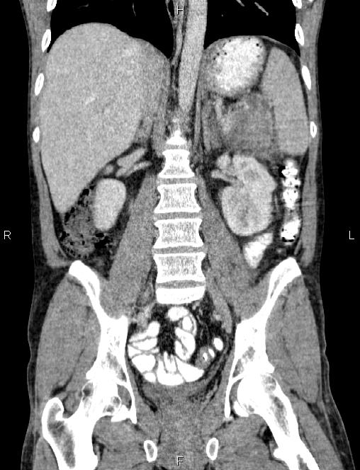 Autoimmune pancreatitis (Radiopaedia 84925-100431 D 36).jpg