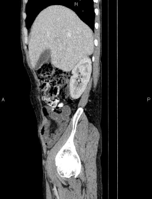 Autoimmune pancreatitis (Radiopaedia 84925-100431 E 23).jpg