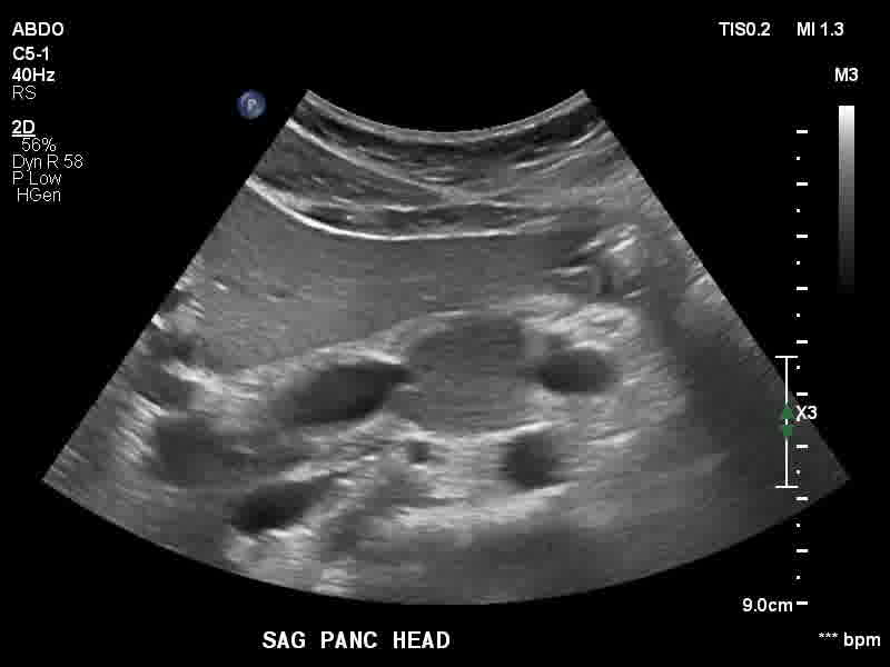 File:Autoimmune pancreatitis (Radiopaedia 88443-105100 C 18).jpg