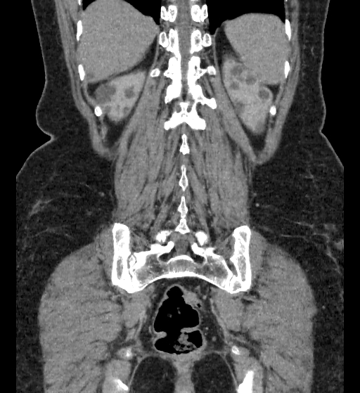 File:Autosomal dominant polycystic kidney disease (Radiopaedia 38189-40194 Coronal C+ delayed 86).jpg