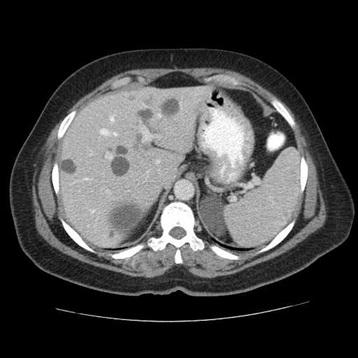 File:Autosomal dominant polycystic kidney disease with hepatic involvement (Radiopaedia 32693-33662 B 15).jpg