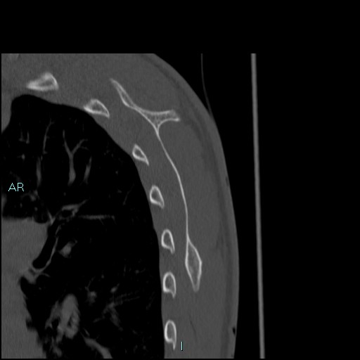 Avascular necrosis after fracture dislocations of the proximal humerus (Radiopaedia 88078-104653 Sagittal bone window 74).jpg