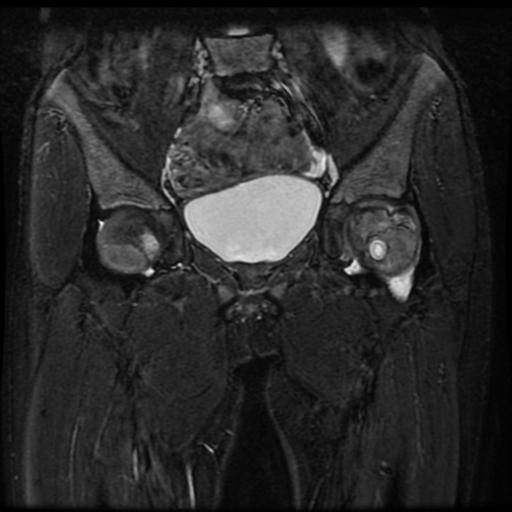 File:Avascular necrosis of the hip (Radiopaedia 29563-30067 Coronal T2 fat sat 5).jpg