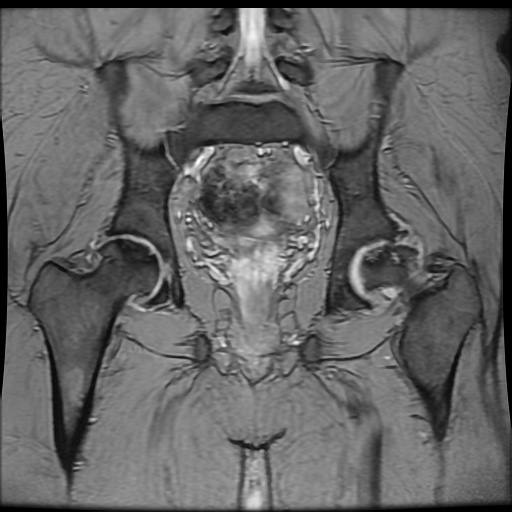 Avascular necrosis of the hip (Radiopaedia 61503-69465 F 60).jpg