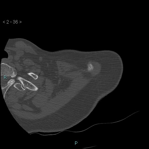 Avascular necrosis of the shoulder - Cruess stage I (Radiopaedia 77674-89887 Axial bone window 9).jpg