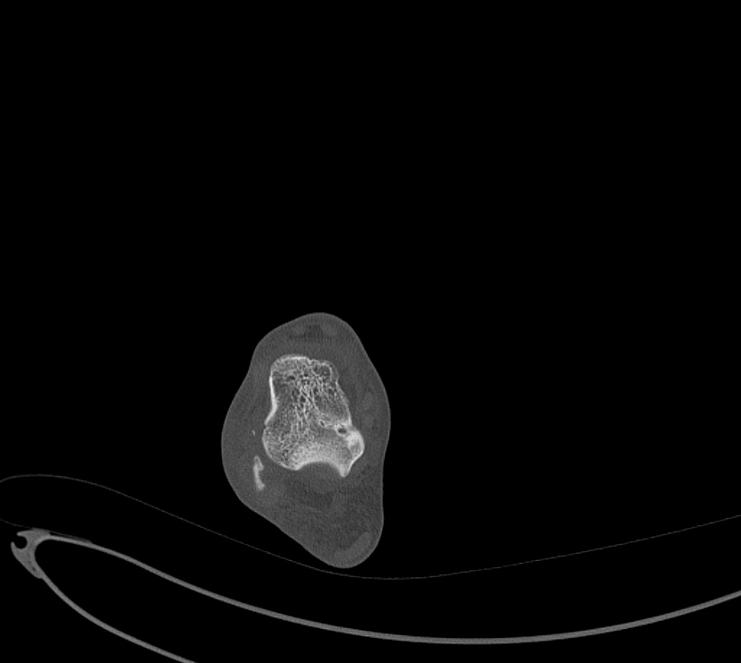 Avulsion fractures of talus and calcaneus (Radiopaedia 48277-53155 Axial bone window 30).jpg