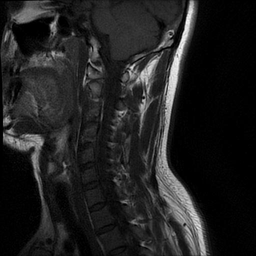 File:Axis fracture - MRI (Radiopaedia 71925-82375 Sagittal T1 3).jpg