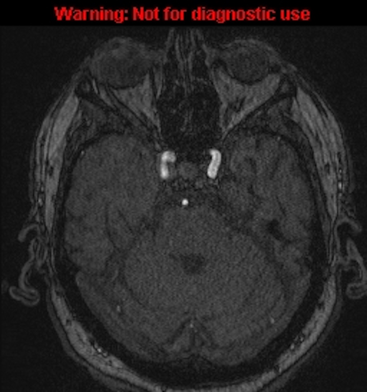 Azygos anterior cerebral artery (Radiopaedia 59325-66677 Axial MRA 47).jpg