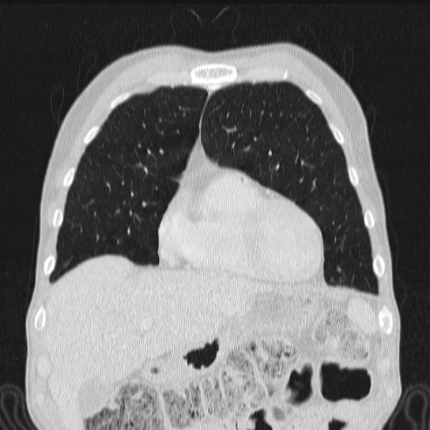 Azygos lobe (Radiopaedia 38259-40275 Coronal lung window 21).jpg