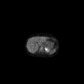 B-cell lymphoma of the mesentery (Radiopaedia 65743-74868 18F-FDG PET-CT 163).jpg