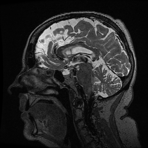 Balo concentric sclerosis (Radiopaedia 53875-59982 Sagittal 3D FSE 136).jpg