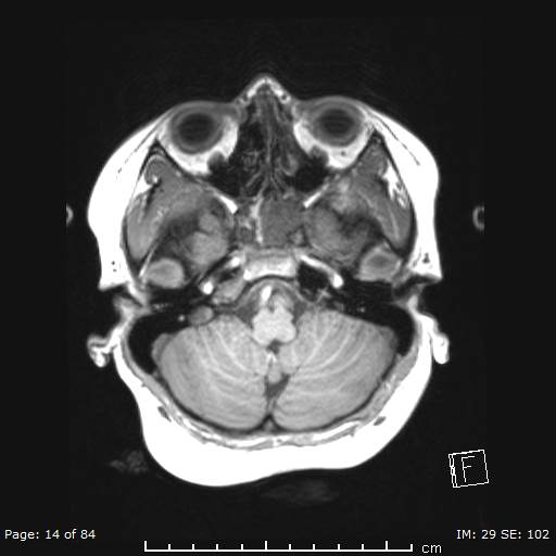File:Balo concentric sclerosis (Radiopaedia 61637-69636 Axial T1 14).jpg