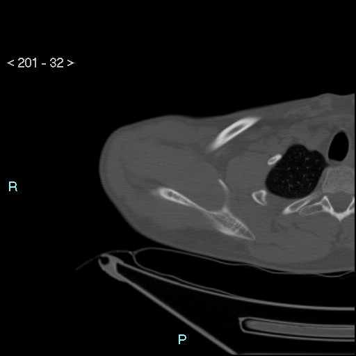 File:Bankart lesion with glenoid bone defect - assessment TC with PICO method (Radiopaedia 42855-93901 Axial bone window 31).jpg