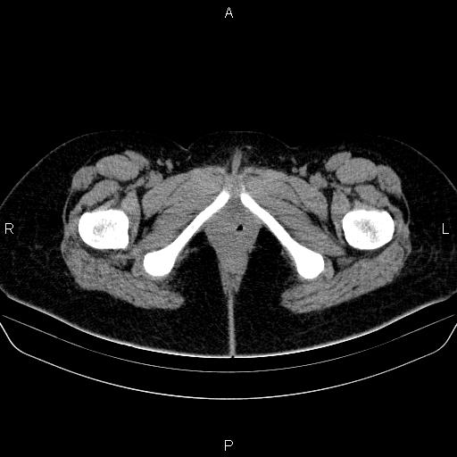 Bartholin gland cyst (Radiopaedia 62635-70930 Axial non-contrast 91).jpg