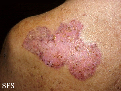 Basal Cell Carcinoma (Dermatology Atlas 84).jpg
