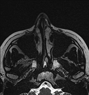 File:Basal cell carcinoma - nasal region (Radiopaedia 70292-80365 Axial Gradient Echo 17).jpg
