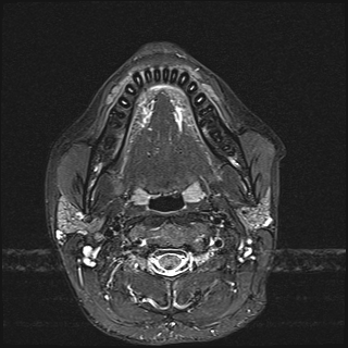 File:Basal cell carcinoma - nasal region (Radiopaedia 70292-80365 Axial STIR 25).jpg