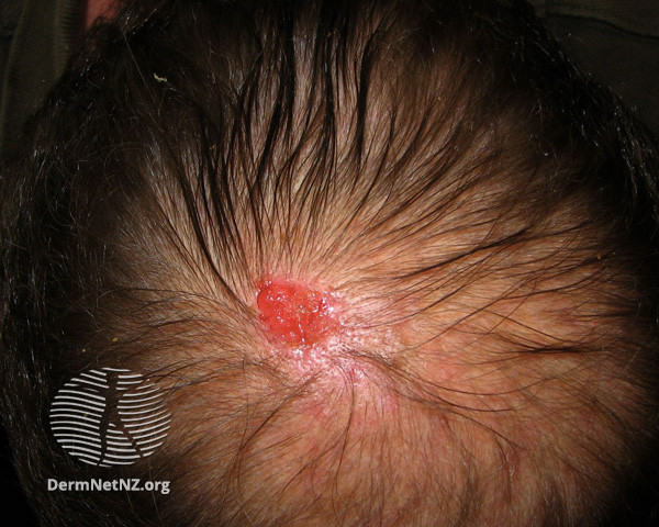 File:Basal cell carcinoma affecting the face (DermNet NZ lesions-bcc-face-0666).jpg