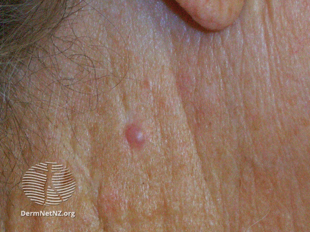 File:Basal cell carcinoma affecting the face (DermNet NZ lesions-bcc-face-0771).jpg