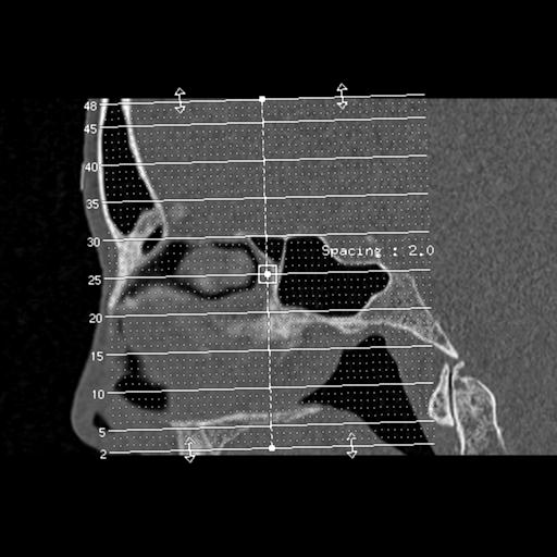 File:Base of skull chondrosarcoma (Radiopaedia 30410-31071 Axial bone window 1).jpg