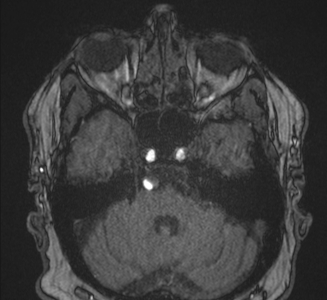 Basilar artery dissection (Radiopaedia 77032-88976 Axial TOF 52).jpg