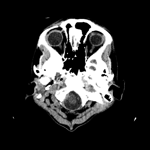 File:Basilar artery perforator aneurysm (Radiopaedia 82455-96597 Axial non-contrast 1).jpg