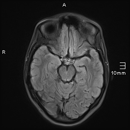 File:Basilar artery perforator aneurysm (Radiopaedia 82455-99523 Axial FLAIR 9).jpg