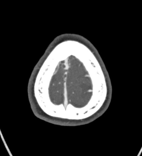 Basilar tip aneurysm with coiling (Radiopaedia 53912-60086 A 140).jpg