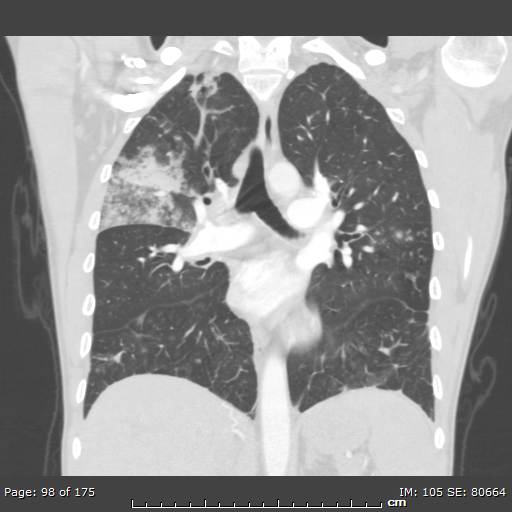 Behçet disease (Radiopaedia 44247-47889 Coronal lung window 29).jpg