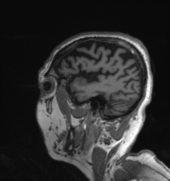 Behavioral variant frontotemporal dementia and late onset schizophrenia (Radiopaedia 52197-58083 Sagittal T1 7).png