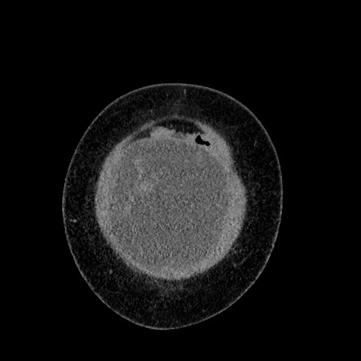 File:Benign leiomyoma with hydropic features (Radiopaedia 89250-106130 B 12).jpg