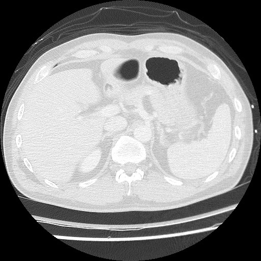 Benign post-traumatic pseudopneumoperitoneum (Radiopaedia 71199-81495 Axial lung window 69).jpg