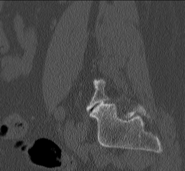 Bertolotti syndrome (Radiopaedia 24864-25128 Sagittal bone window 47).jpg
