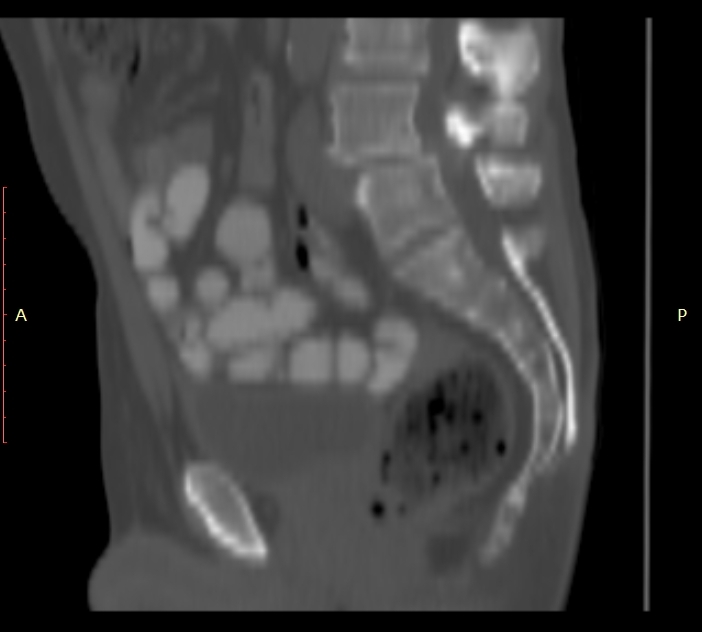 Bertolotti syndrome (Radiopaedia 58974-66235 Sagittal bone window 25).jpg