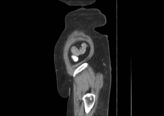 Bicameral celiacomesenteric aneurysm (Radiopaedia 55766-62327 B 53).jpg