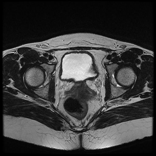 File:Bicornuate uterus (Radiopaedia 51676-57472 Axial T2 14).jpg