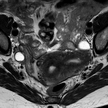 File:Bicornuate uterus (Radiopaedia 61974-70046 Axial T2 2).jpg