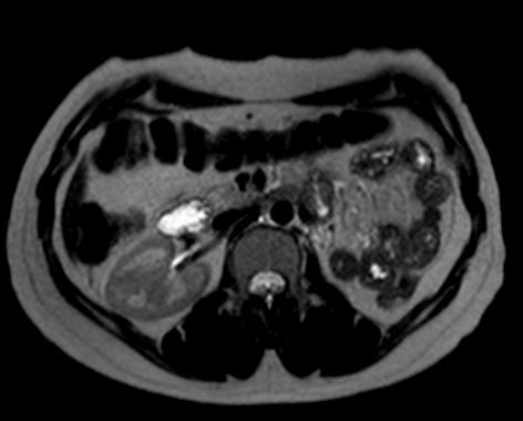 File:Bicornuate uterus with left renal agenesis (Radiopaedia 19829-19879 E 1).JPG