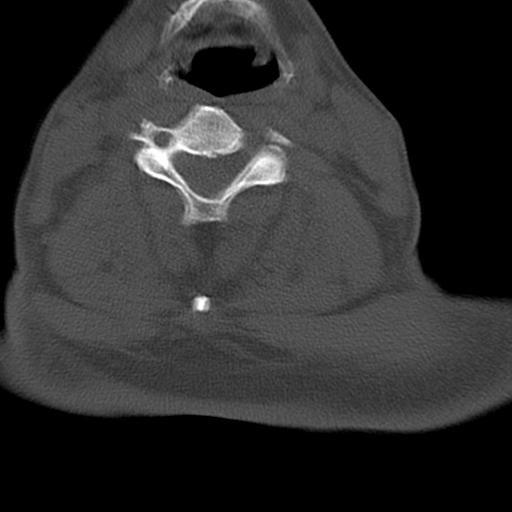 File:Bilateral C6-7 locked facet dislocation (Radiopaedia 28506-28748 Axial bone window 9).jpeg