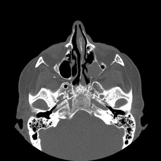File:Bilateral Ectopic Infraorbital Nerves (Radiopaedia 49006-54084 Axial bone window 15).jpg
