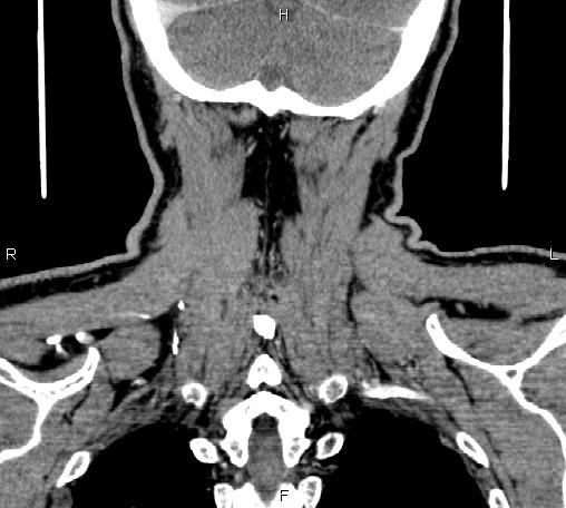 File:Bilateral Warthin tumors (Radiopaedia 84034-99263 C 47).jpg
