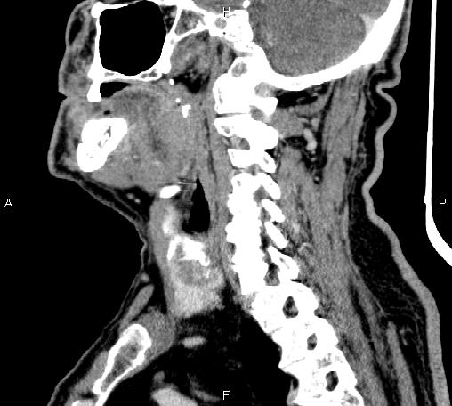 Bilateral Warthin tumors (Radiopaedia 84034-99263 D 36).jpg