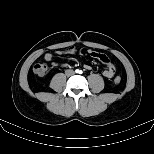 Bilateral accessory renal arteries with mild pelvi-ureteric junction (PUJ) obstruction (Radiopaedia 66357-75596 A 38).jpg