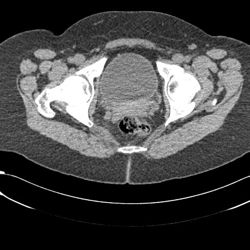 Bilateral acetabular protrusion with pincer type femoro-acetabular impingement (Radiopaedia 30134-30733 AXIAL SOFT THIN 48).jpg